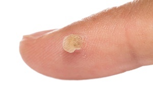 En vorte er en hudsykdom som effektivt bekjemper Skincell Pro