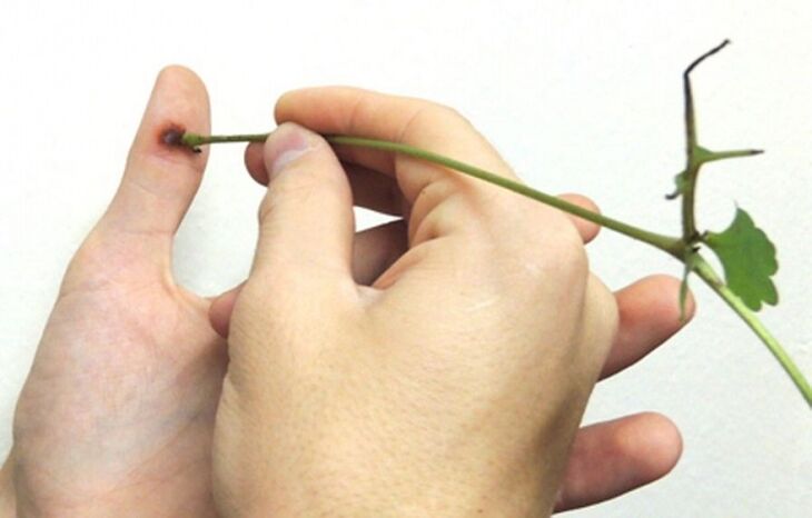 fjerning av en vorte på en finger med celandine urtesaft